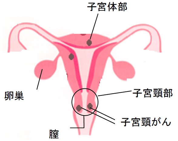 ハタチからの子宮頸がん検診画像