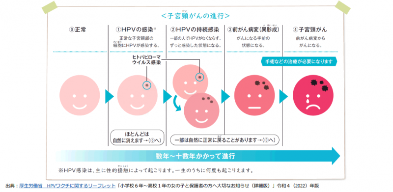 子宮頸がんの進行