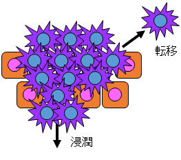 転移浸潤